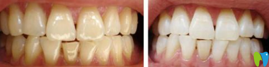 昆明拜博口腔怎么樣？親們可以參考我的潔牙<span style=