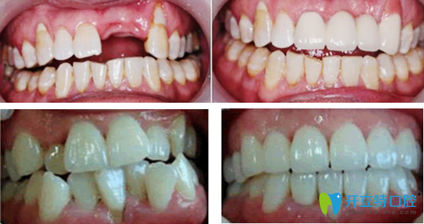 牙祖口腔種植牙+牙齒矯正效果案例 牙祖口腔種植牙+牙齒矯正效果案例