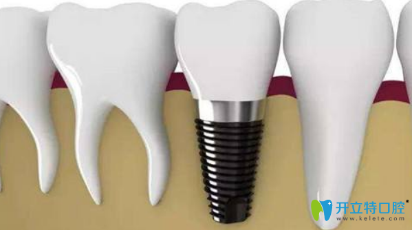種植牙的組成部分