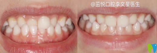 成都茁悅口腔門(mén)診6歲孩子矯正牙齒術(shù)后圖