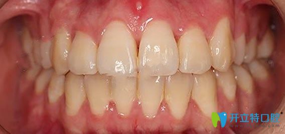 好大夫口腔牙齒不齊矯正后效果圖
