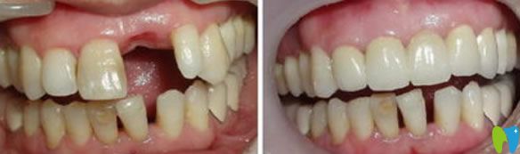 長沙美奧口腔黃穎醫(yī)生種植效果圖 長沙美奧口腔黃穎醫(yī)生種植效果圖