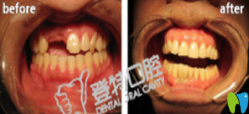廈門登特口腔林軍龍種植牙前后效果對比圖