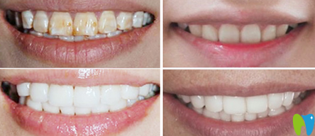 廈門登特口腔林鋆牙齒美白前后效果對比圖