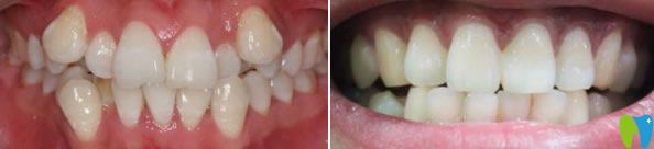 美奧口腔牙齒矯正前后對(duì)比圖 美奧口腔牙齒矯正前后對(duì)比圖