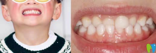 6歲孩子換牙期做牙齒正畸 成都茁悅口腔成功矯正了咬合錯位