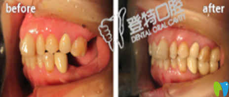 廈門登特口腔黃華生種植牙效果對比圖