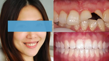 長沙拜博口腔怎么樣 用種植牙/正畸/烤瓷牙修復(fù)效果來回答