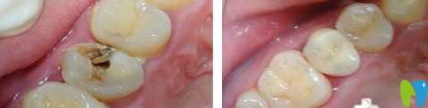 泰州北極星口腔齲齒修復(fù)前后對(duì)比圖