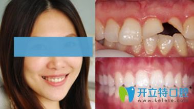 拜博口腔門牙缺損烤瓷牙修復(fù)案例