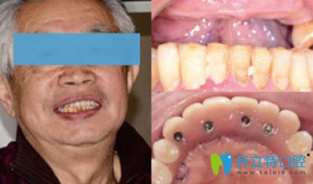 拜博口腔張玉林醫(yī)生種植牙效果案例 拜博口腔張玉林醫(yī)生種植牙效果案例