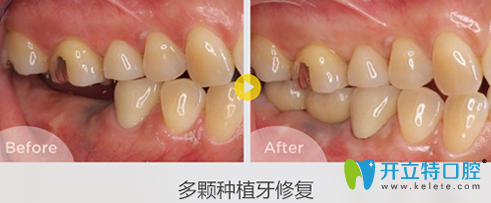泰州北極星口腔種植牙案例效果對(duì)比圖