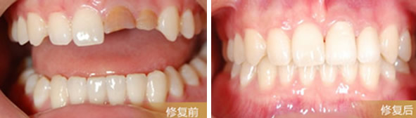 朋友問天津陽光樹口腔是公立還是私立？烤瓷牙做的怎么樣