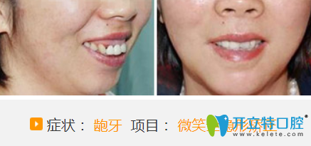 聊城哪家醫(yī)院牙齒正畸好？看聊城口腔微笑全隱形牙齒矯正案例對比圖