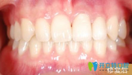 缺損牙齒全瓷牙修復后的效果