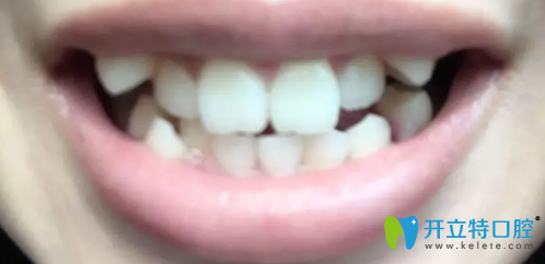 沒有去無錫臻品口腔做牙齒矯正前樣子