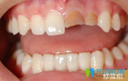 天津陽光樹口腔烤瓷牙修復牙齒前