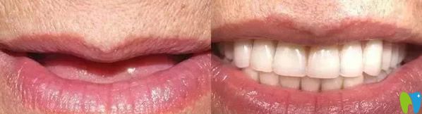 金鉑利口腔韓相國(guó)院長(zhǎng)種植牙案例