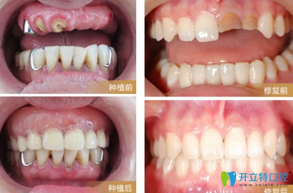 天津陽(yáng)光樹(shù)口腔種植牙+牙齒修復(fù)效果案例