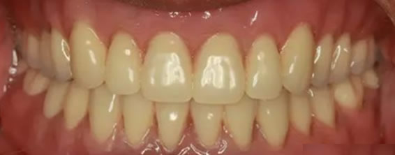 長沙好大夫口腔種植效果案例 看82歲全口牙缺失變形記