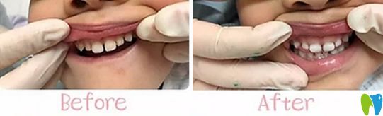 <!--<i data=20240703-sp></i>-->兒童口腔好不好？不妨看看孩子牙齒矯正案例效果