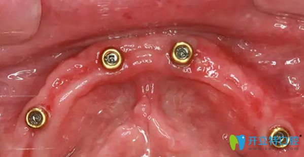 <!--<i data=20240703-sp></i>-->全口牙缺失種植前