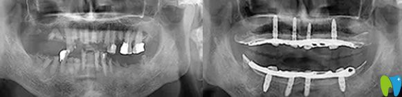 電腦設(shè)計(jì)種植后效果圖