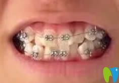 沈陽博得口腔鎮(zhèn)診所金屬托槽牙齒矯正圖 沈陽博得口腔鎮(zhèn)診所金屬托槽牙齒矯正圖