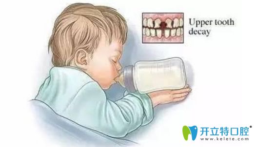 兒童奶瓶齒齲怎么治療?如何避免兒童奶瓶齲?準媽媽必看寶典