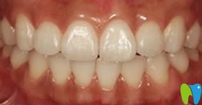 沈陽皇姑博得口腔牙齒矯正成功圖 沈陽皇姑博得口腔牙齒矯正成功圖