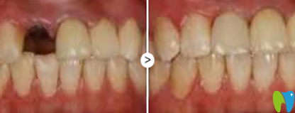 寧波口腔種植牙前后效果對比圖