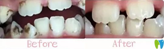 <!--<i data=20240703-sp></i>-->兒童口腔齲齒治療前后對比效果