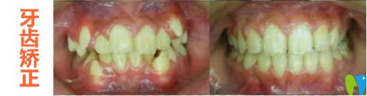 杭州美奧兒童牙齒矯正前后對比效果