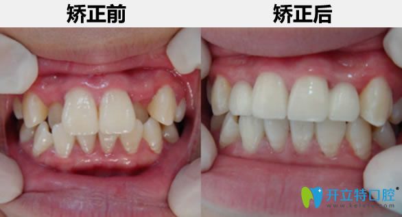 28歲顧客矯正牙齒前后對比照