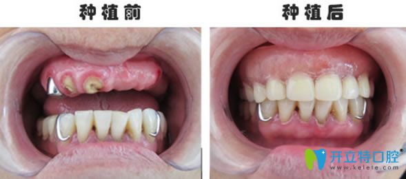 60歲老人半口即刻種植牙前后對比效果