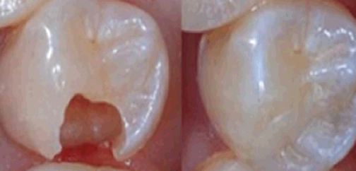 鄭州雅美口腔根管治療后的效果對比圖 鄭州雅美口腔根管治療后的效果對比圖