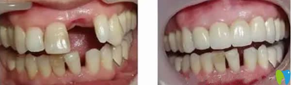 北京齒康口腔種植牙效果案例