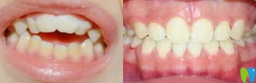 成都維朗口腔尹秋丹的兒童牙齒正畸效果圖 成都維朗口腔尹秋丹的兒童牙齒正畸效果圖