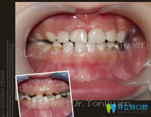 維恩口腔蛀牙治療前后對比案例