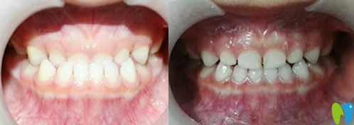 閆立文乳牙反頜（地包天）矯正案例