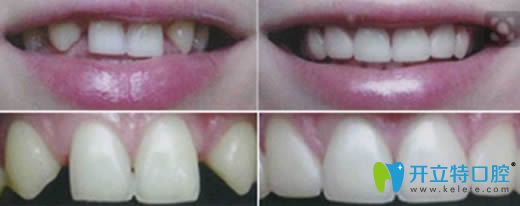 成都維朗口腔楊陽牙齒修復(fù)效果圖