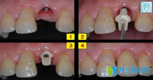 成都維朗口腔種植牙效果圖