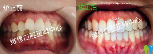 牙醫(yī)楊占娟怎么樣？看維恩口腔楊占娟真人案例