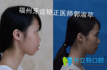 牙醫(yī)郭淑蘋(píng)時(shí)代天使隱形矯正案例對(duì)比效果