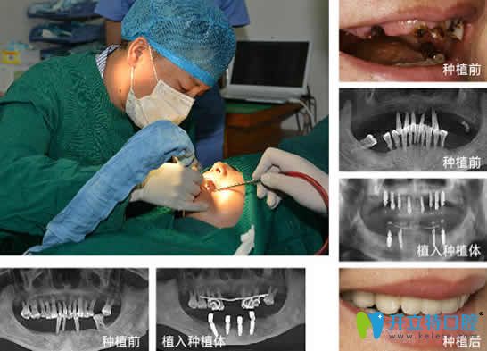 <!--<i data=20240703-sp></i>-->口腔全慶波種植牙案例效果圖
