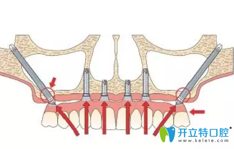 穿顴種植的利弊解析