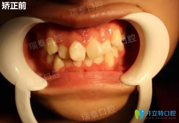 記錄我去西安瑞泰口腔做時代天使隱形矯正14個月以來的感受