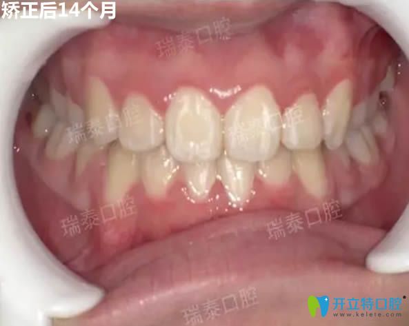 時(shí)代天使隱形矯正14個(gè)月后效果圖