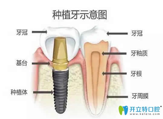 無(wú)錫康貝佳口腔醫(yī)生揭露：比種植牙更好的方法及價(jià)格