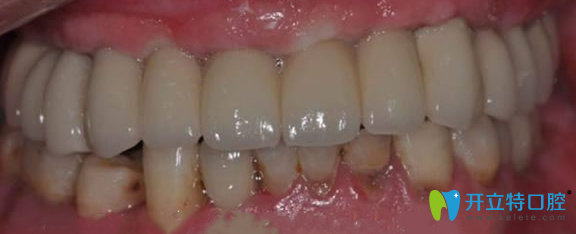 半口牙缺失術(shù)后效果圖 半口牙缺失術(shù)后效果圖